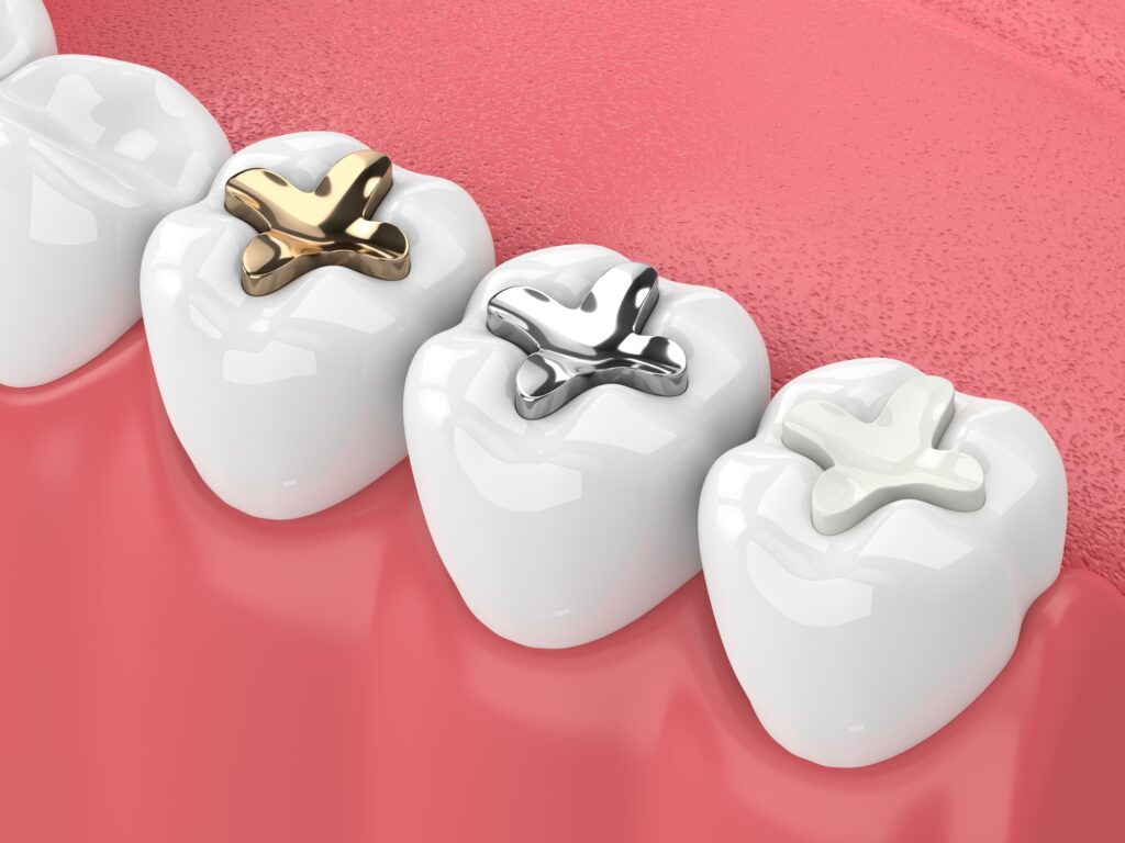 3D illustration of dental fillings in molars, showing silver and tooth-colored materials.
