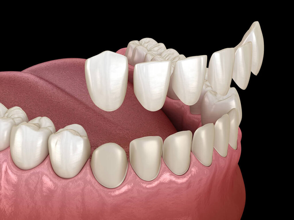 3D illustration showing porcelain veneers being applied to teeth.