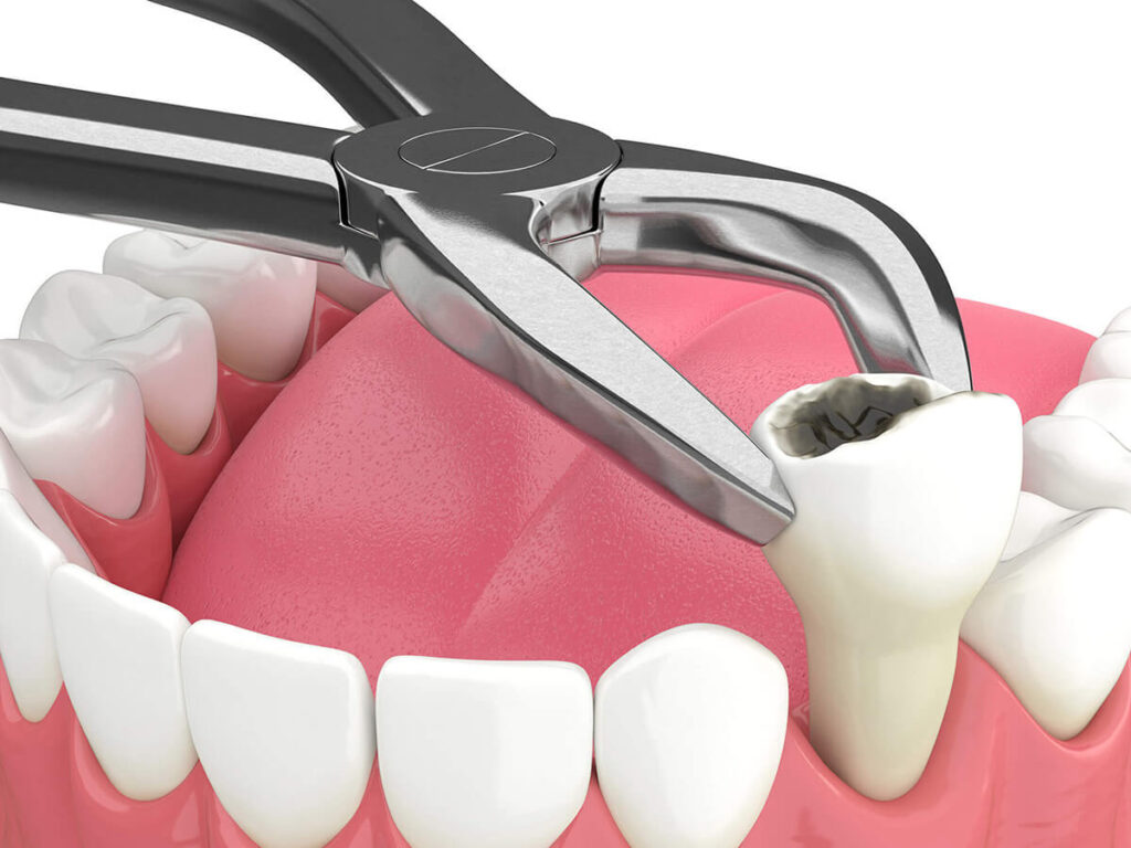 3D visual of a tooth extraction with forceps in a clinical dental model.